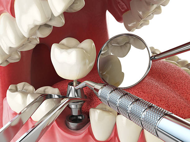 Best Broken or Chipped Tooth Repair in South Whitley, IN